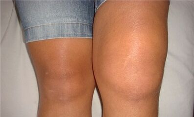 Causes of knee arthritis