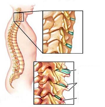 Compare healthy and sick vertebrae in the neck