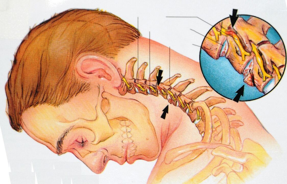 Fiber of the cervix area