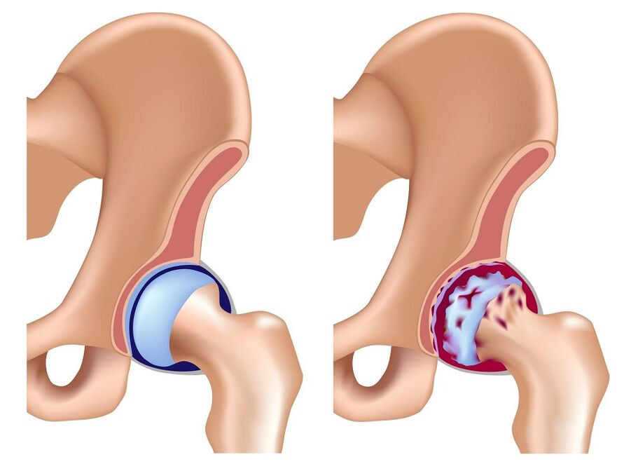 healthy joints and hip arthritis